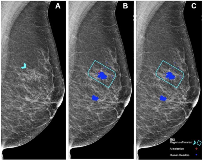 Photo de 3 images de mammographie, mise en comparaison pour lecture.